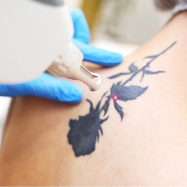 Laser Tattoo Removal Treatment Overview
