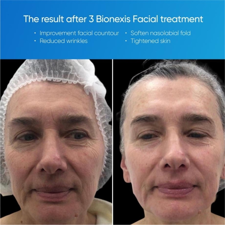 bionexislitepro-104 (1).jpg My default image