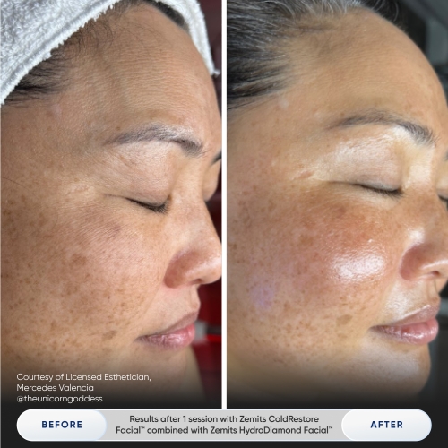 Results after 1 session with Zemits ColdRestore Facial™ combined with Zemits HydroDiamond Facial™.jpg My default image