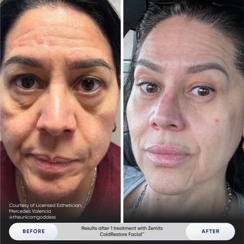 Results after 1 treatment with Zemits ColdRestore Facial™.jpg My default image