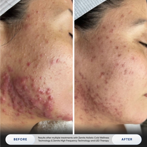 Results after multiple treatments with Zemits Holistic Cold Wellness Technology & Zemits High Frequency Technology and LED Therapy.jpg My default image