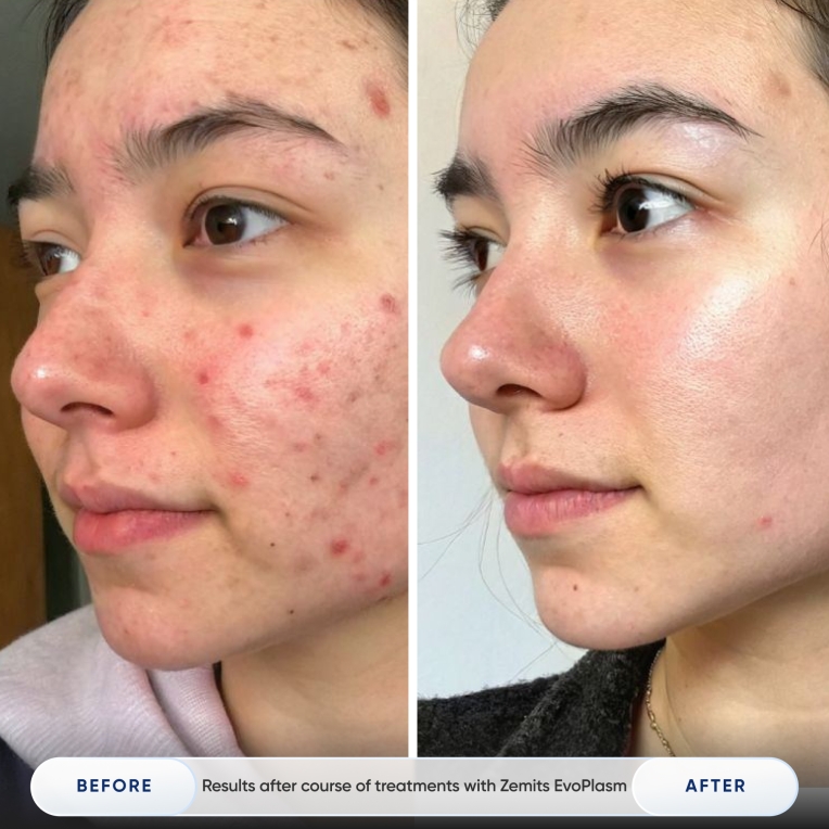 Results after course of treatments with Zemits EvoPlasm_1.jpg My default image