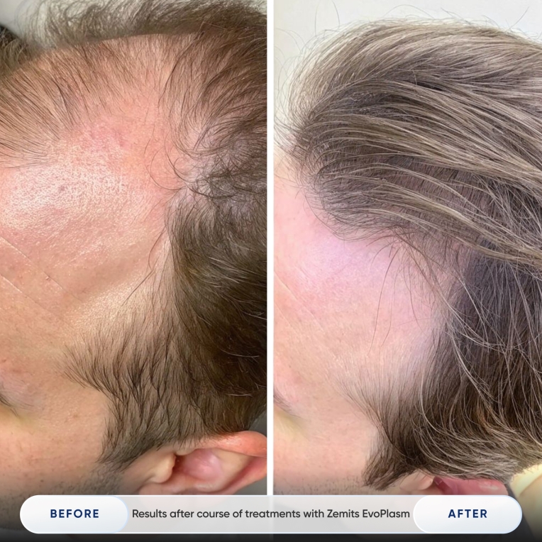 Results after course of treatments with Zemits EvoPlasm_3.jpg My default image