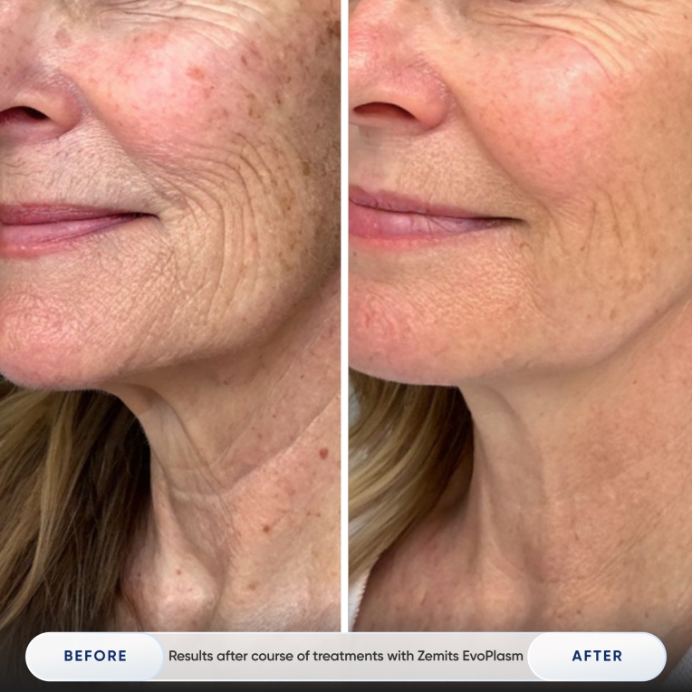 Results after course of treatments with Zemits EvoPlasm_2.jpg My default image