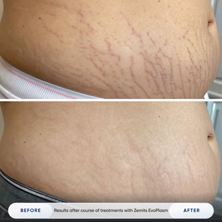 Results after course of treatments with Zemits EvoPlasm_4.jpg My default image