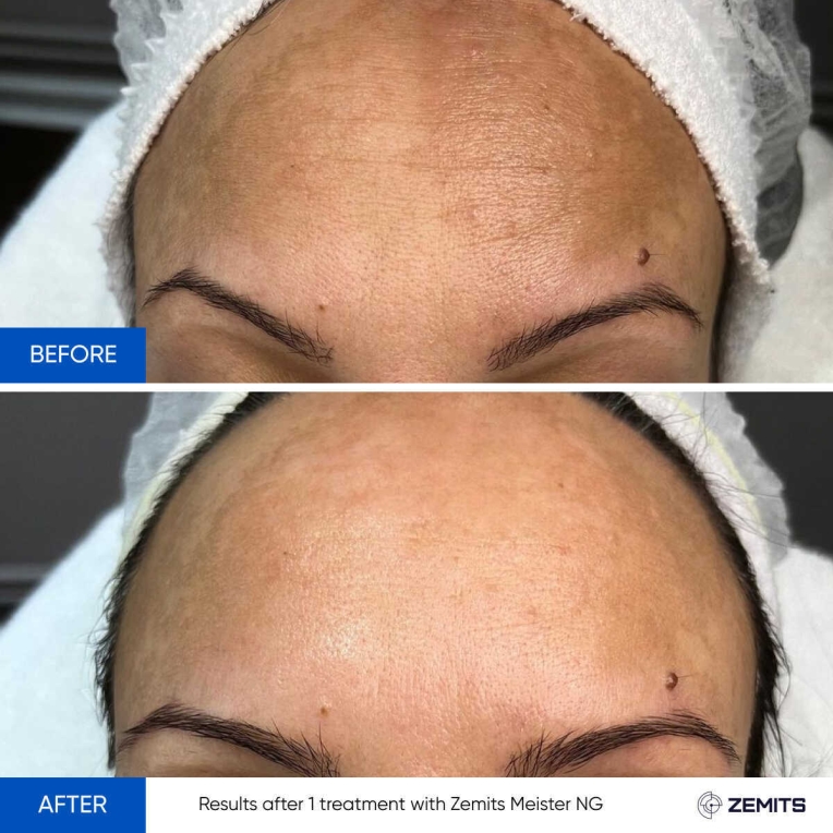 Zemits Meister NG Full-Feature Facial System FOR SALE