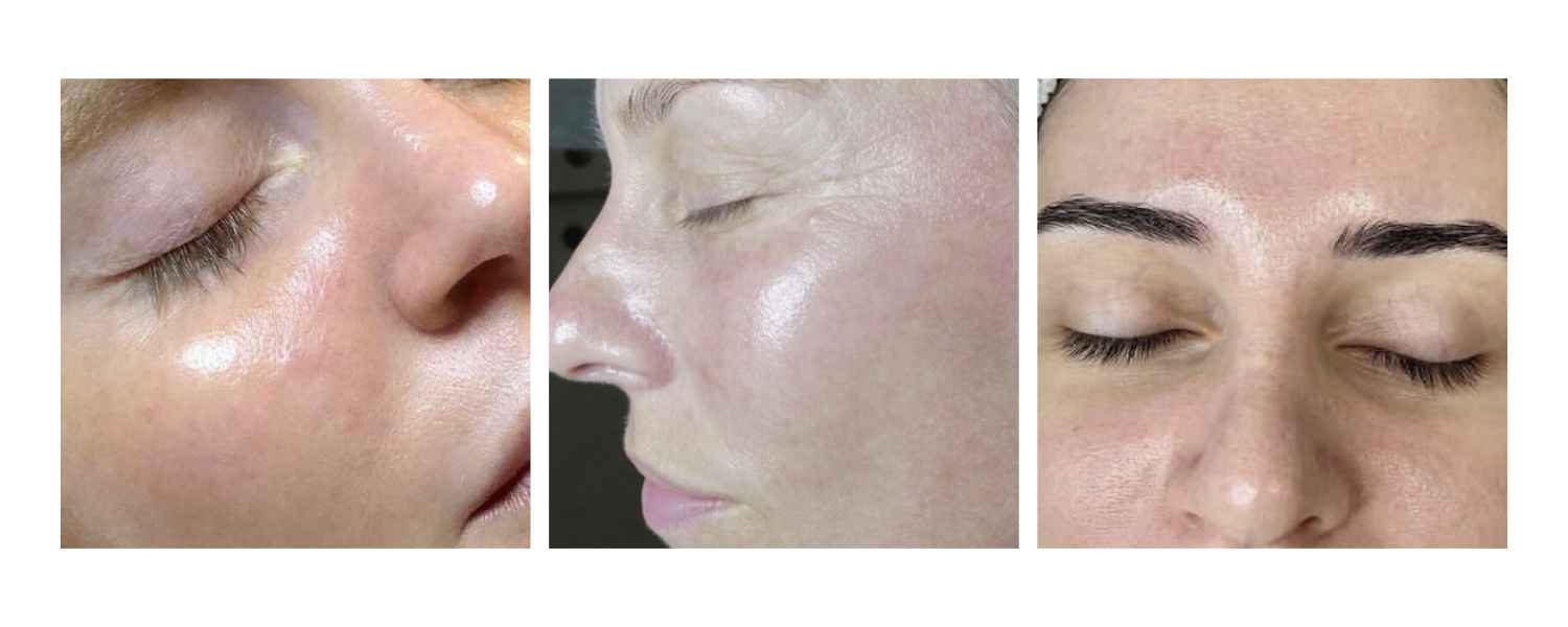 Zemits SalicPure Pro HydroDermabrasion Serum with Salicylic Acid