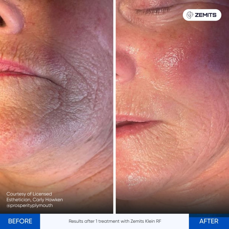 美容機器 タッチスクリーン RFクリーム付き Amazon | skinix(スキニックス) エアウォールIV レギュラー