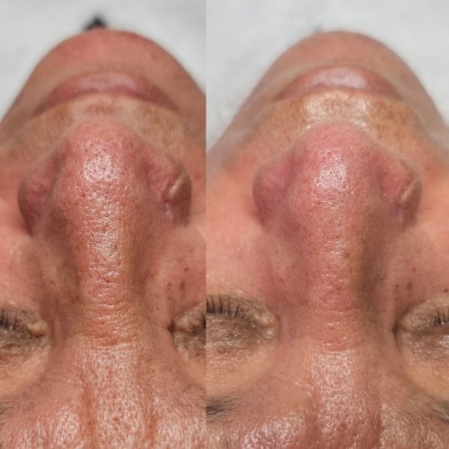 HydroDiamond Facial Results