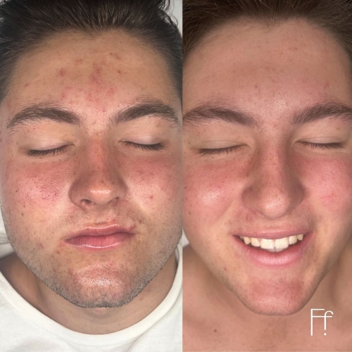 HydroDiamond Facial Results