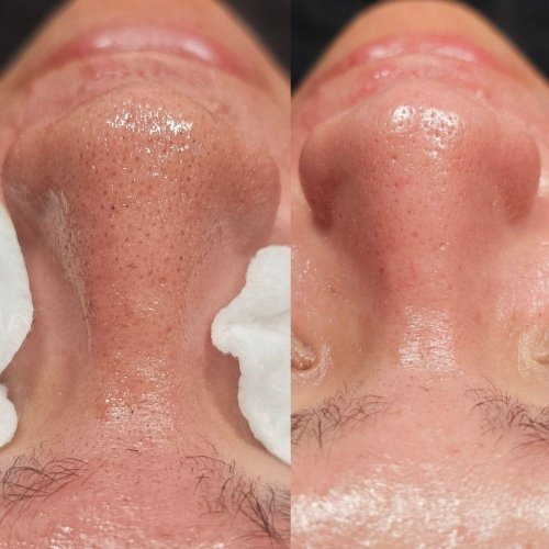 HydroDiamond Facial Results