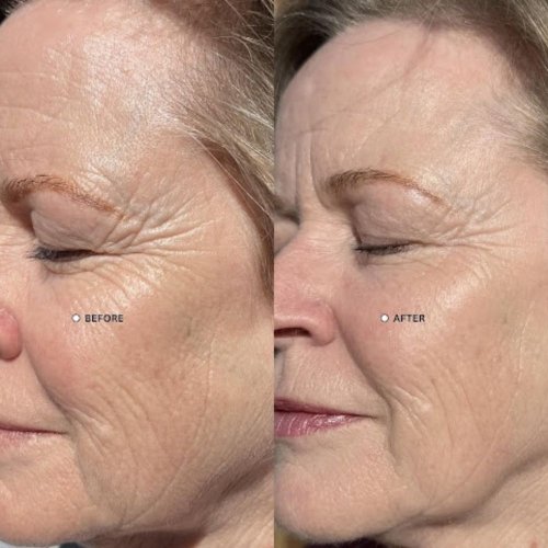 HydroDiamond Facial Results