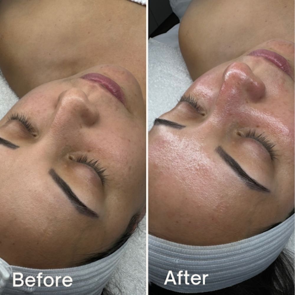 HydroDiamond Facial Results