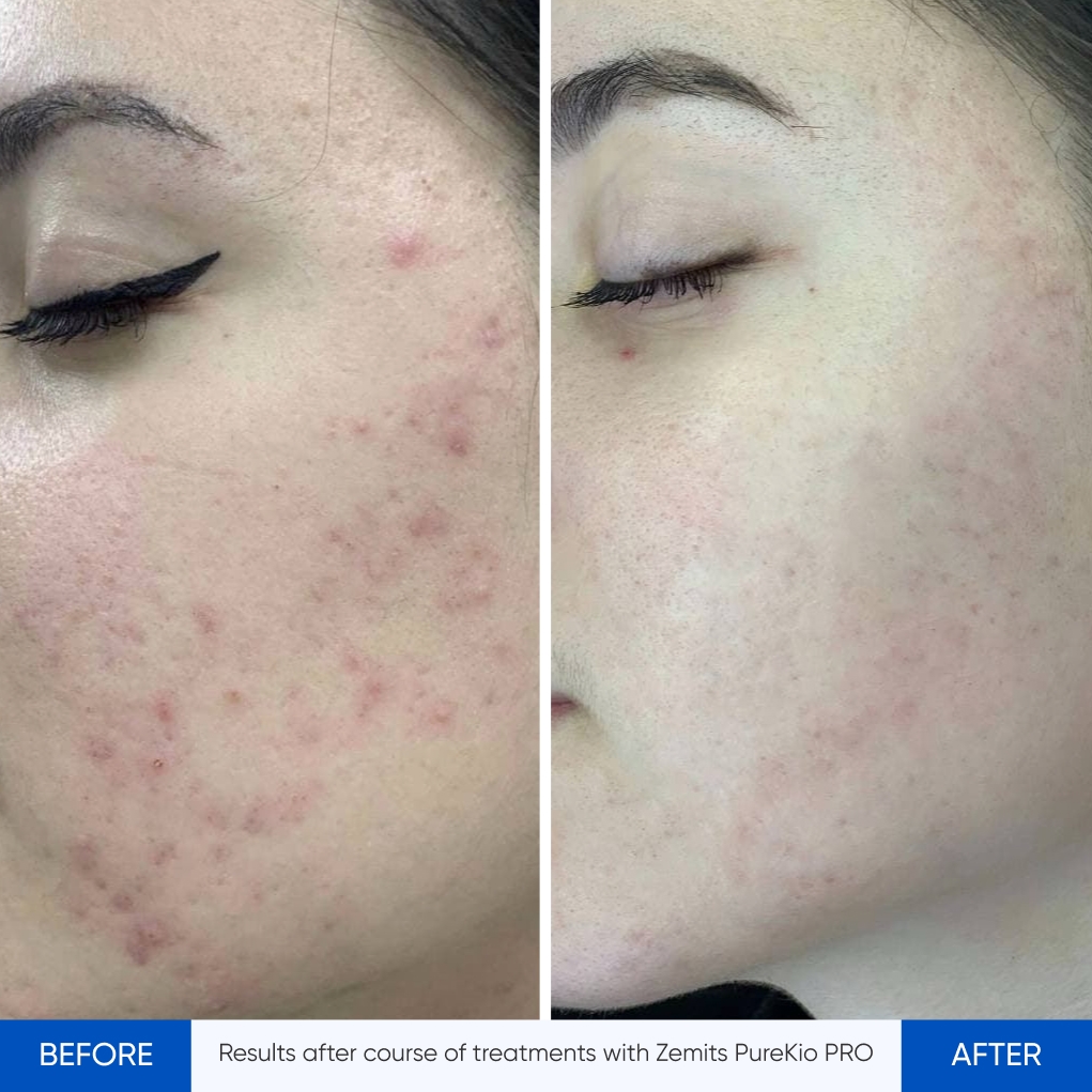 Results after course of treatments with Zemits PureKio PRO.jpg My default image