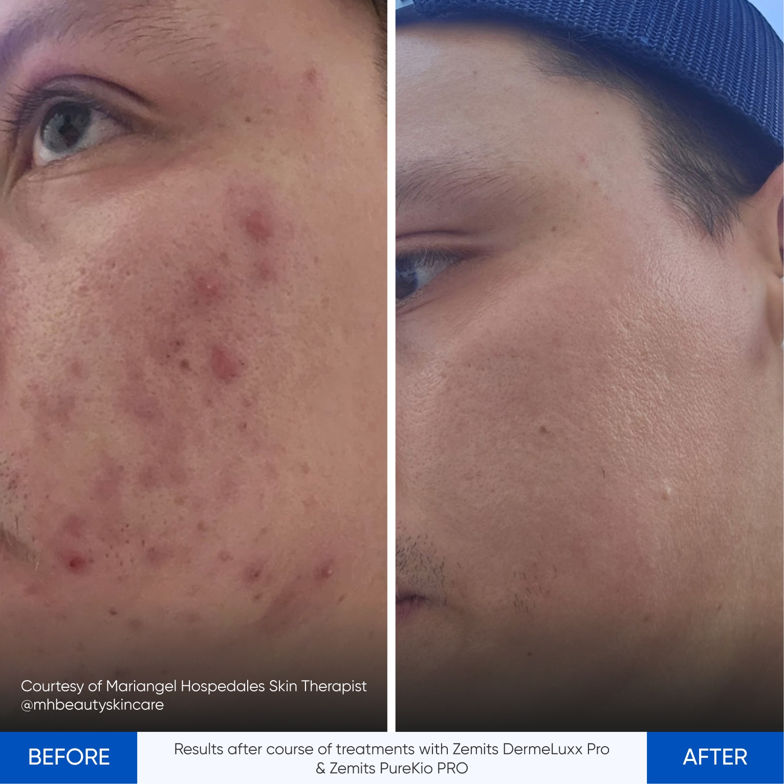 Zemits DermeLuxx Pro & Zemits PureKio PRO_Results after course of treatments_1.jpg My default image