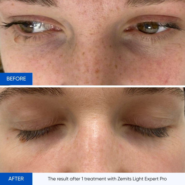 The result after 1 treatment with Zemits Light Expert_.jpg My default image