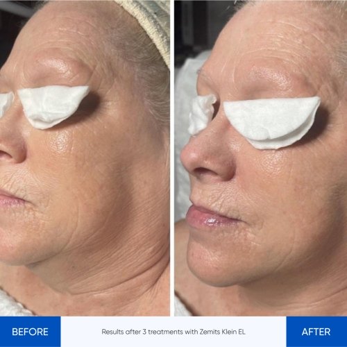 Results Klein ELBefore After 5.jpg My default image