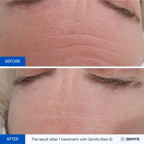 The result after 1 treatment with Zemits Klein El.jpg My default image