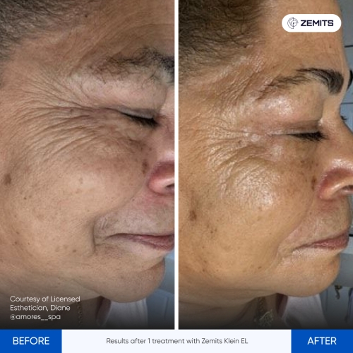 Results Klein ELBefore After 3.jpg My default image