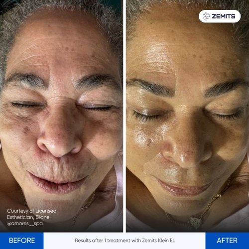 Results Klein ELBefore After 4.jpg My default image