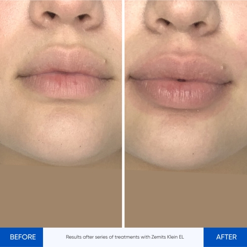 Results Klein ELBefore After 2.jpg My default image