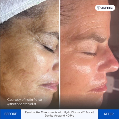 Results Ashley Ford Verstand HD & OxiVelour Before After_2-1 (2).jpg My default image