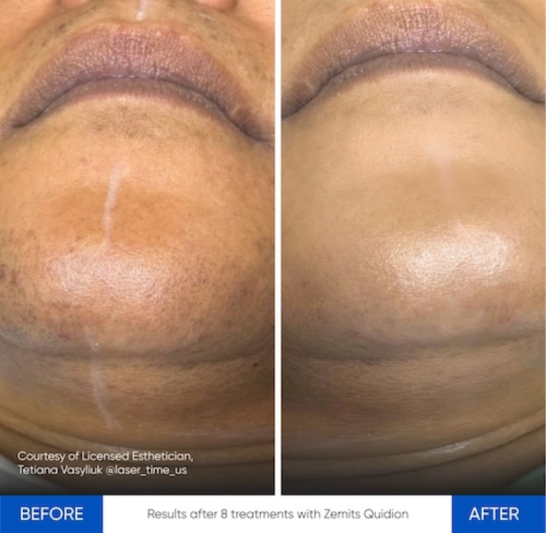 Results Quidion Before After 12.jpg My default image
