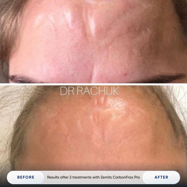 Zemits CarbonFrax Pro CO₂ Laser_resalt_1.jpg My default image