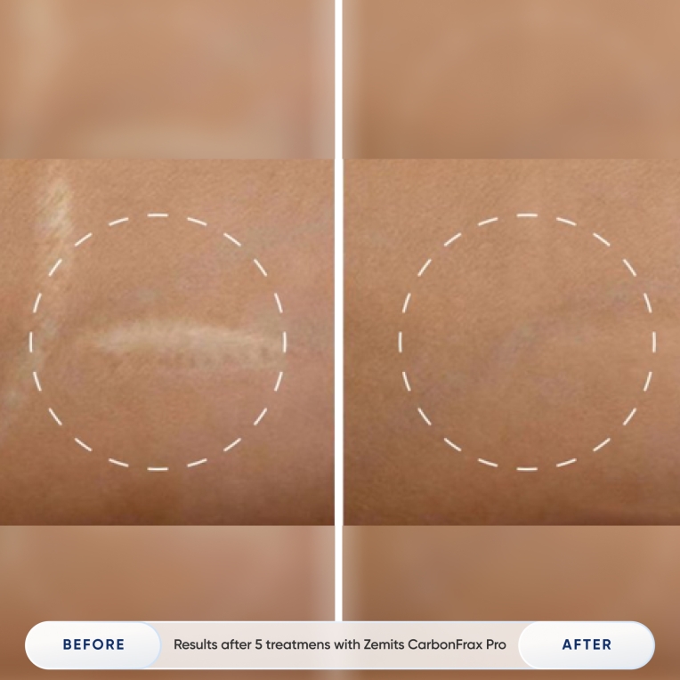 Zemits CarbonFrax Pro CO₂ Laser_resalt_2.jpg My default image