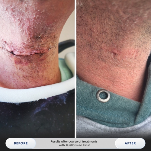 Results after 1 treatment with Zemits Holistic Cold Wellness Technology-1.jpg My default image