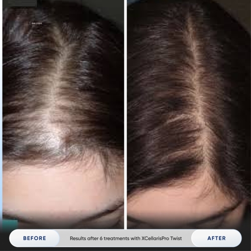 Results after 1 treatment with Zemits Holistic Cold Wellness Technology-2.jpg My default image