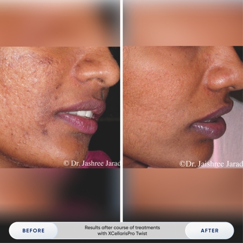 Results after 1 treatment with Zemits Holistic Cold Wellness Technology-3.jpg My default image