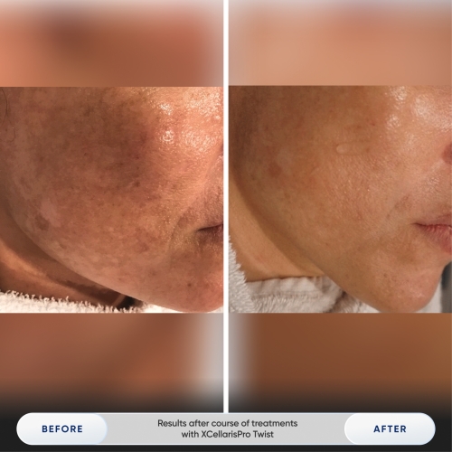 Results after 1 treatment with Zemits Holistic Cold Wellness Technology-5.jpg My default image