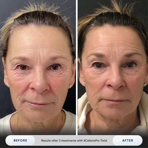 Results after 1 treatment with Zemits Holistic Cold Wellness Technology.jpg My default image