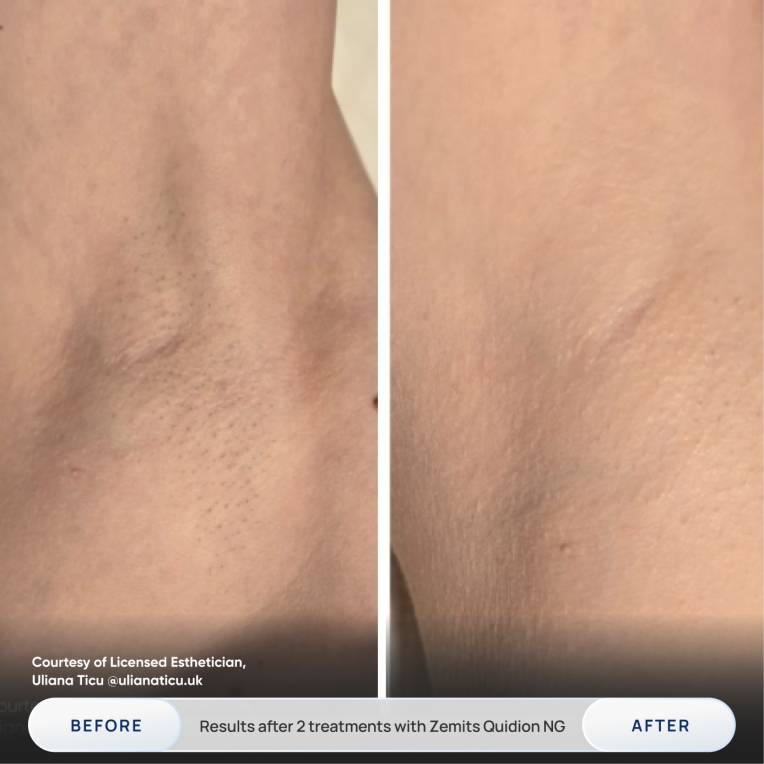 Courtesy of Licensed Esthetician, Uliana Ticu @ulianaticu.uk BEFORE Results after 2 treatments with Zemits Quidion NG AFTER_1.jpg My default image