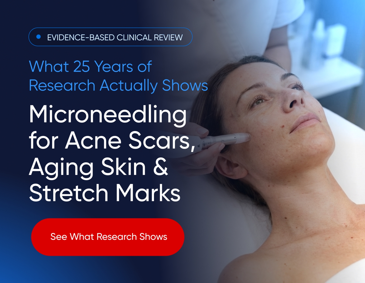 Microneedling for Acne Scars banner.jpg My default image