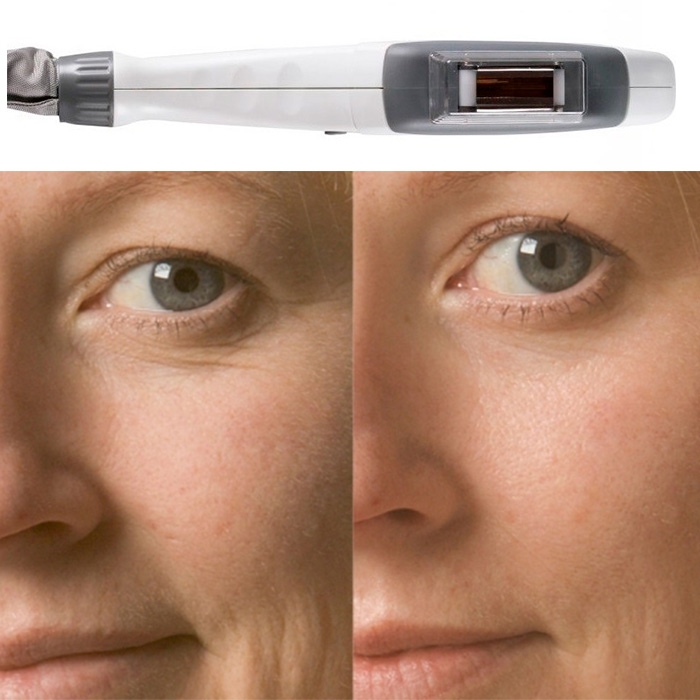 WRINKLE REDUCTION