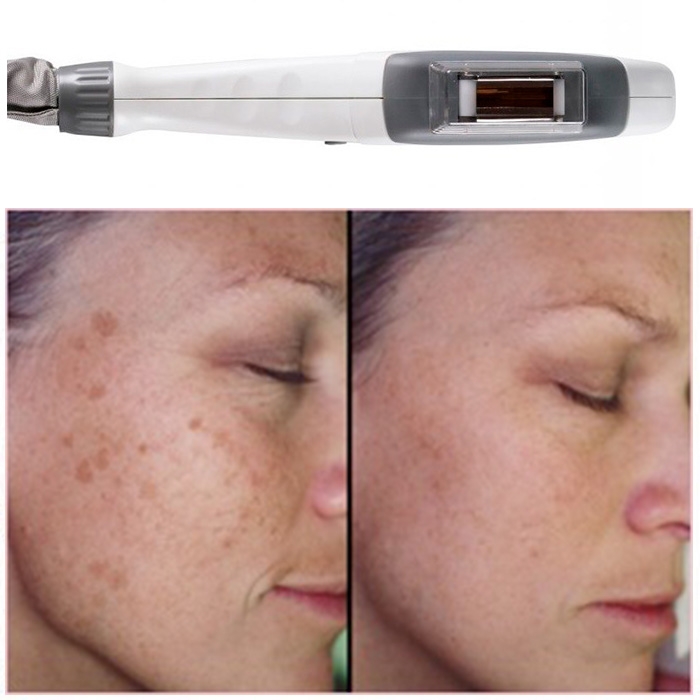 DEPIGMENTATION TREATMENT