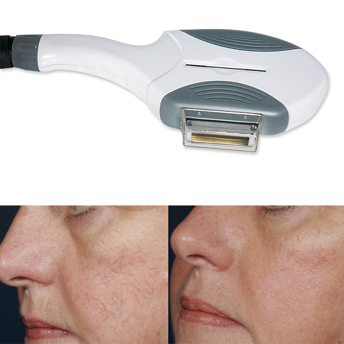 VASCULAR TREATMENT