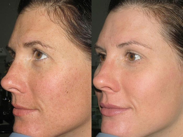 Photorejuvenation- 520 nm