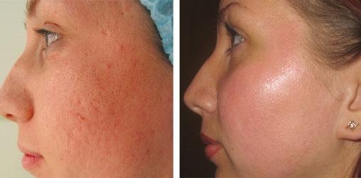 Acne Treatment - 540 nm