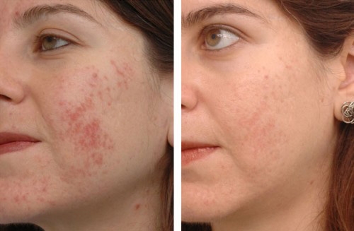 Pigment Reduction- 580 nm