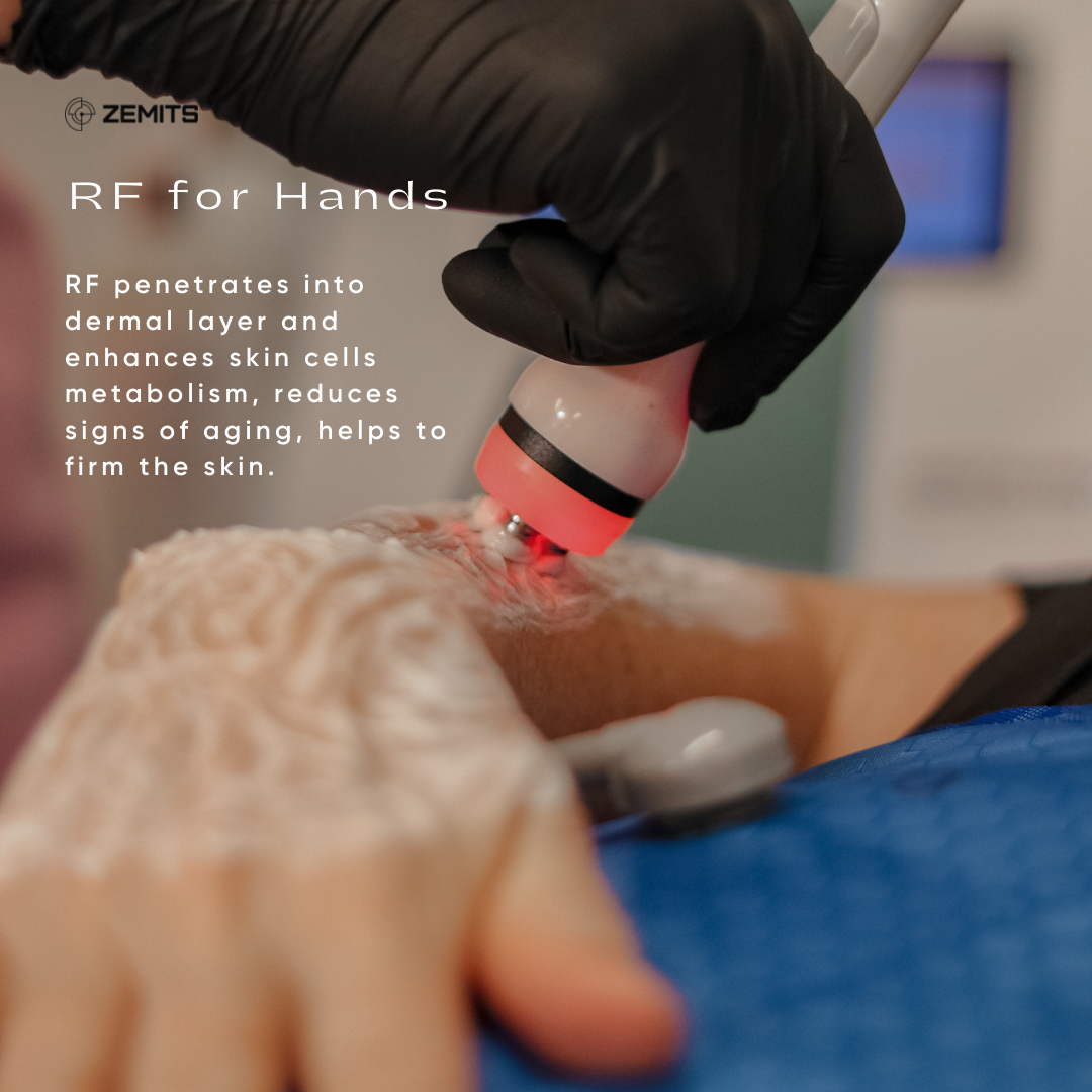 RF Hands Rejuvenation
