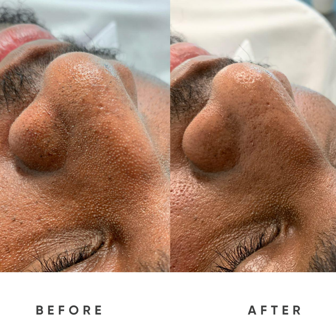 Fluid HydroDermabrasion Enables: