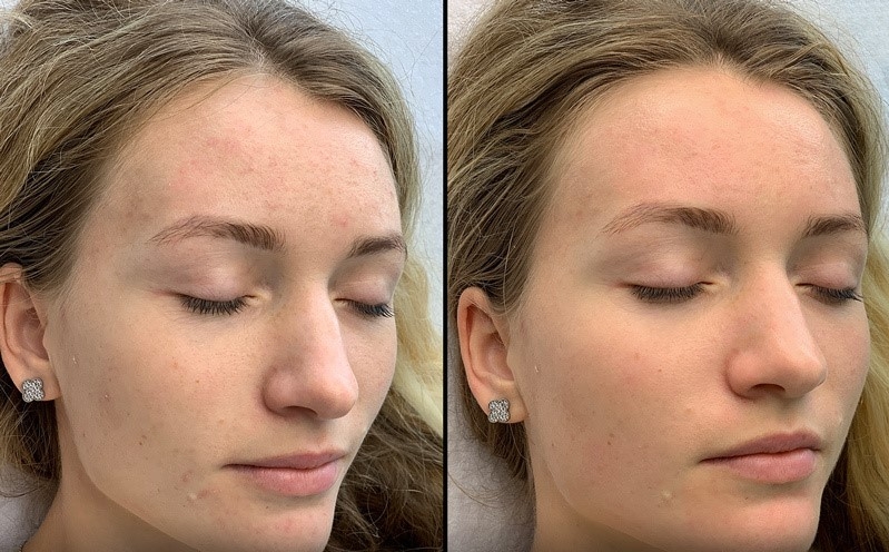 Anti-Acne Treatment Protocol