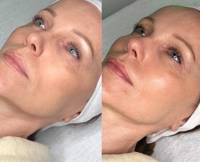 Illuminating Treatment Protocol